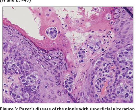 [PDF] Paget's disease of the breast | Semantic Scholar