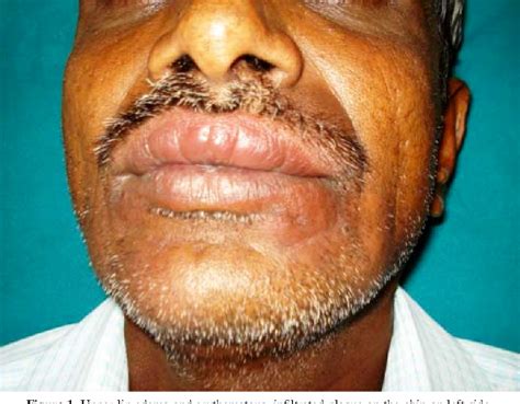 Pdf Borderline Leprosy Masquerading As Cheilitis Granulomatosa A