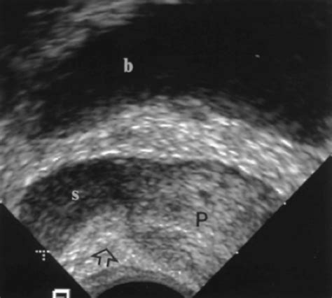 Prostate And Seminal Vesicle Ultrasound Radiology Key