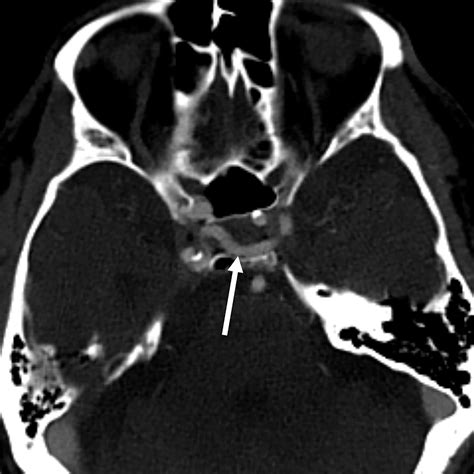 Unilateral Agenesis Of The Internal Carotid Artery With Intracavernous