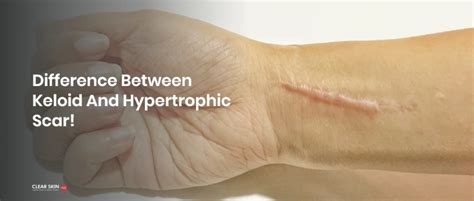 Difference Between Keloid And Hypertrophic Scar Clearskin Pune