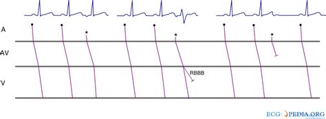 File Aes Svg Ecgpedia