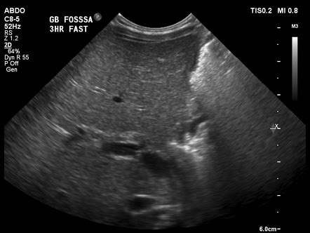 Triangular Cord Sign Biliary Atresia Radiology Reference Article