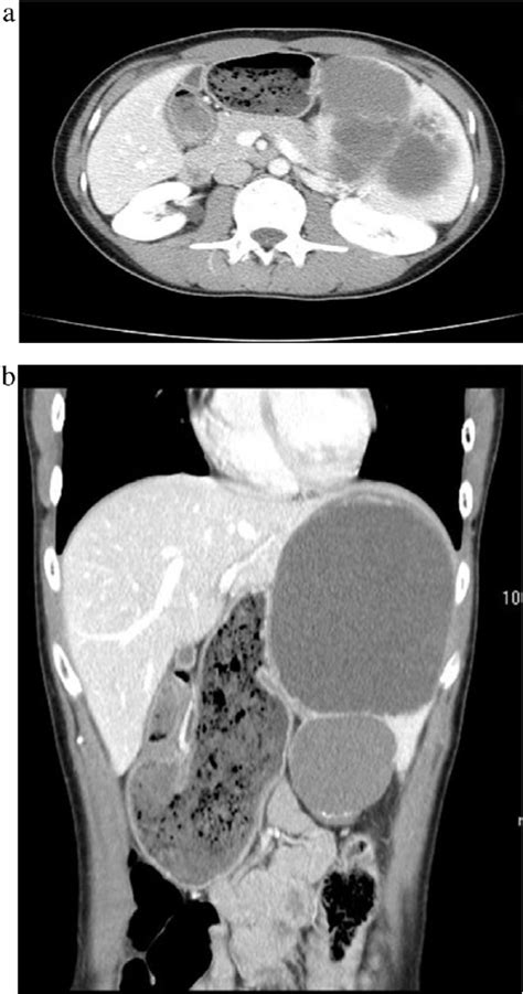 Laparoscopic View Of The Splenic Cyst Download Scientific Diagram