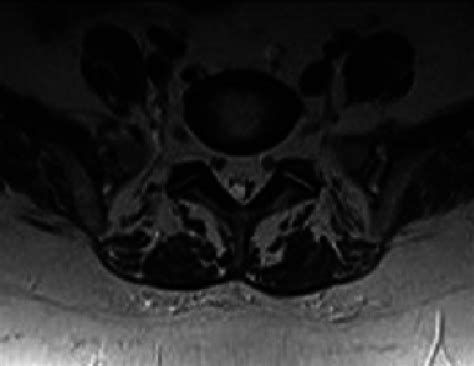 Axial T2-weighted MRI shows compression of the thecal sac and roods ...