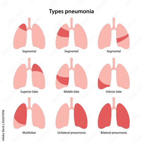 Doctor Explaining Types Of Pneumonia Illustration Stock Vector Image