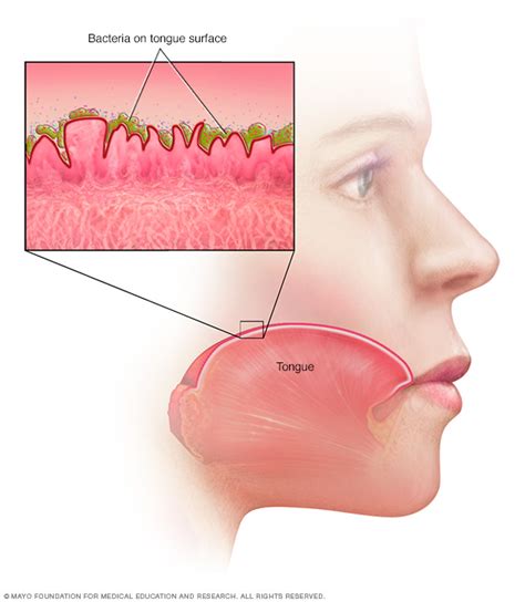 Bad breath Disease Reference Guide - Drugs.com