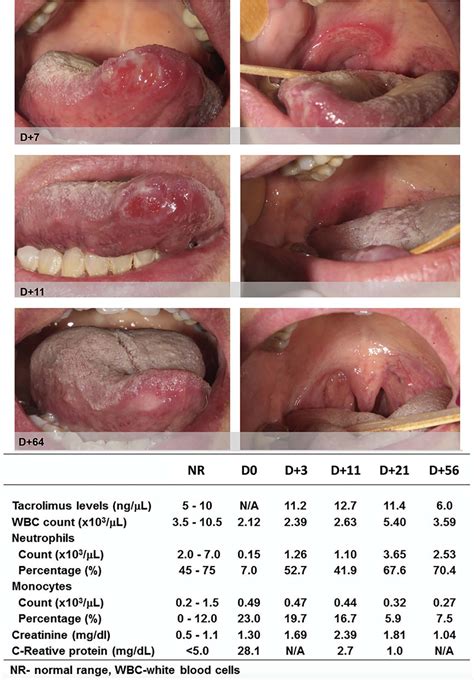 Chronic Painful Oral Ulcers In A Heart Transplant Recipient Oral