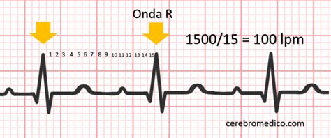 Como Calcular Frequencia Cardiaca No Ecg Irregular Catalog Library