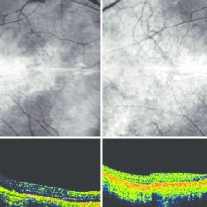 A Stratus Optical Coherence Tomography OCT Of The Right Eye