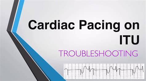 Troubleshooting Transvenous Pacing Cardiac Pacing On ITU YouTube