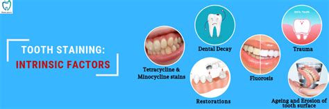 Dental Bleaching Tooth Whitening Treatment In Bellandur Bangalore