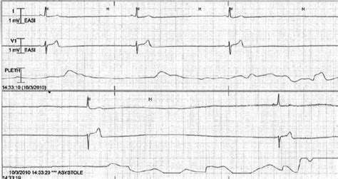 ECG demonstrating sinus bradycardia, followed by sinus arrest with ...