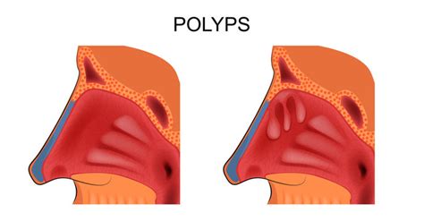 Nasal Polyps Remove Nostrils Obstruction Nosebleed Sinusitis Deviated