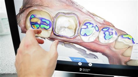 Dental Crown With Cutting Edge Tech Cerec Primescan First Look Youtube