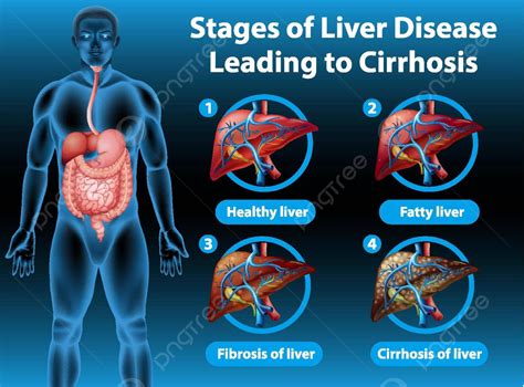 Stages Of Liver Disease Leading To Cirrhosis Drawing Human Educational