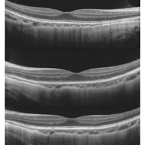 Color fundus in case 5 shows tessellated fundus in both eyes with ...