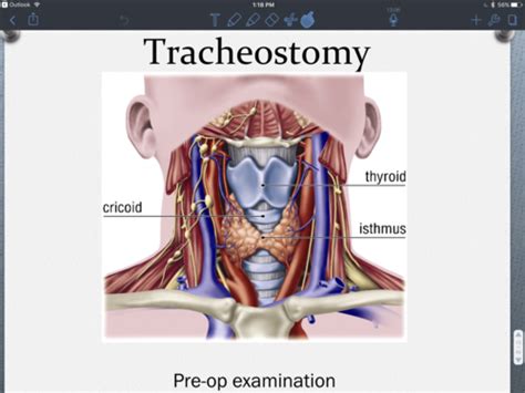 Airway Management Treacheotomy Flashcards Quizlet