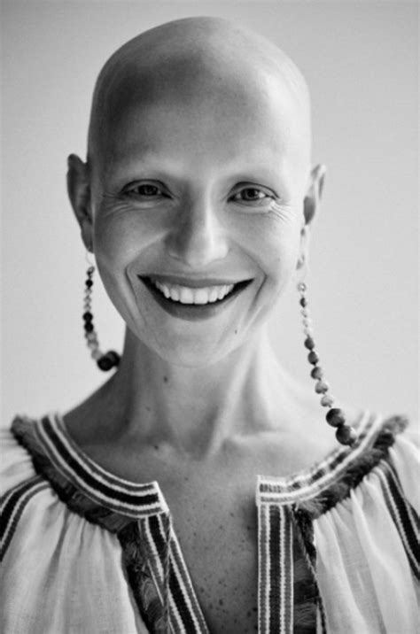 Women With Alopecia Explain How Hair Loss Changed Their Outlooks On