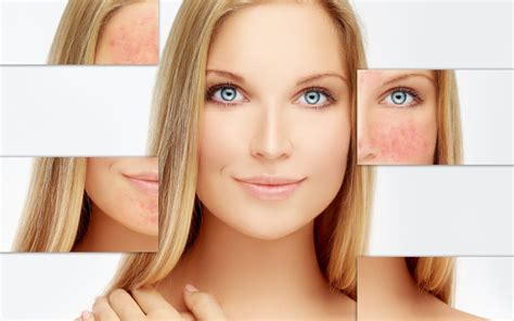 The Truth About Rosacea Causes And Treatments — Spalina Skin Care