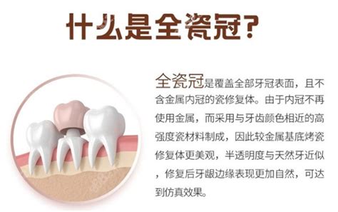 成都牙冠多少钱一颗2022价格表这有成都全瓷牙烤瓷牙价格烤瓷牙 8682整形网