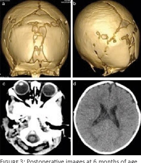 Figure 1 From Metopic Suture Synostosis Trigonocephaly A Case