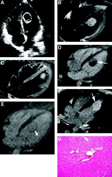 Left Ventricular Apical Mass IQS Executive