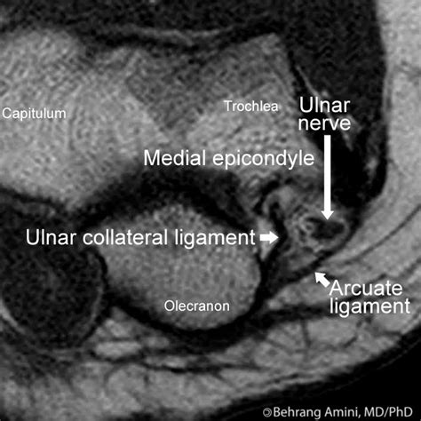 Roentgen Ray Reader Cubital Tunnel