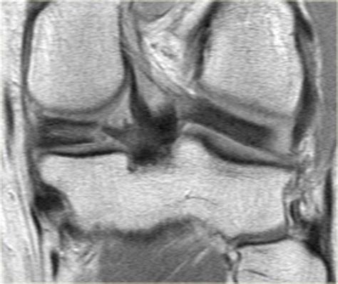 The Radiology Assistant Meniscus Special Cases