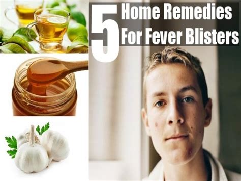 5 Home Remedies For Fever Blisters