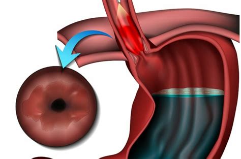 Asge Recommendations For Screening And Surveillance Of Barretts