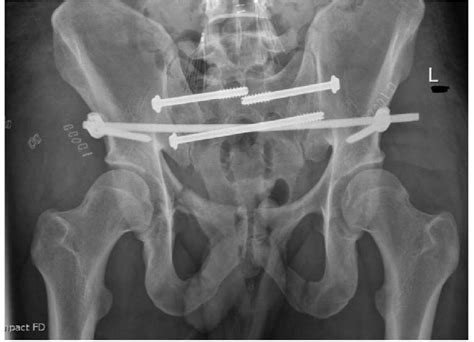 Day 1 After Fixation Bilateral Sacroiliac Joint Screws With Infix