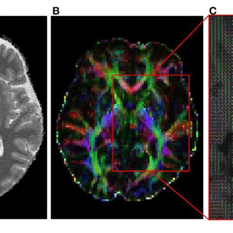 | The habenula in a 3T MRI image and its diffusion tensor image. (A) A... | Download Scientific ...