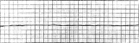 Cardiac Electrophysiology and ECG Interpretation | Clinical Gate