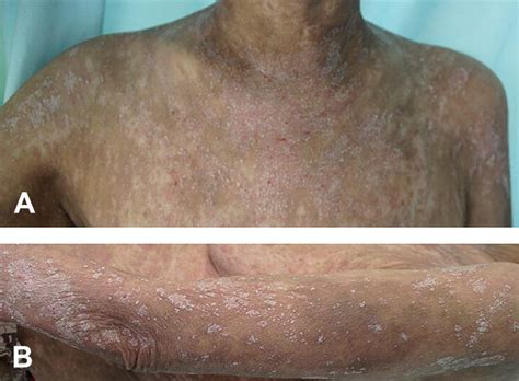 Atopic Dermatitislike Presentation Of Graft Versus Host Disease A