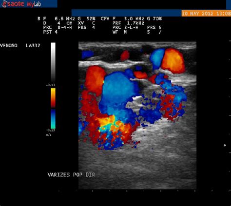 Ultrassom Doppler evidenciando varizes distribuição atípica em