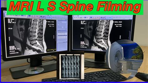 MRI L S SPINE FILMING STEP BY STEP L S Spine Filming In ADW Mri