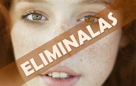 Remedios Caseros Para Eliminar Las Pecas Como Disminuir Las Pecas En