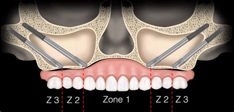 Are Zygomatic Implants Safe Royal Dental Clinics Blog