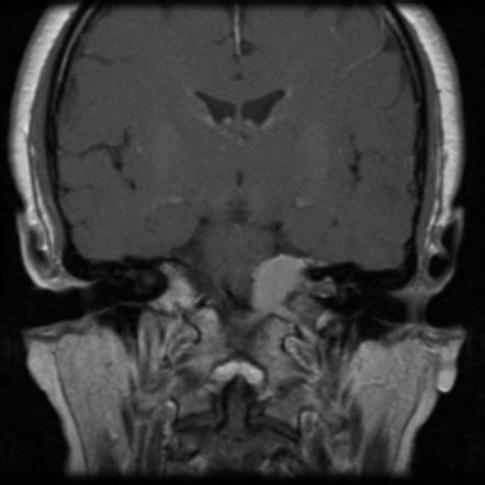 Left petroclival meningioma | Radiology Case | Radiopaedia.org