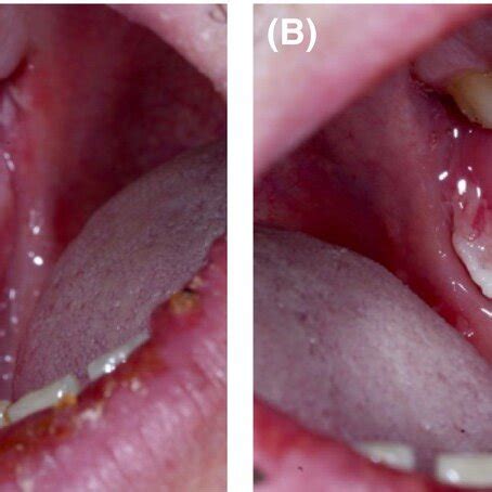 1‐month follow‐up showing the oral mucosa and lips with no previous... | Download Scientific Diagram