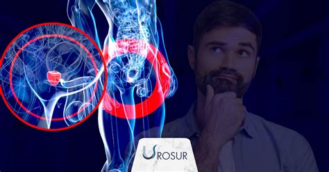 ¿es Posible Prevenir El Cáncer De Próstata Urosur