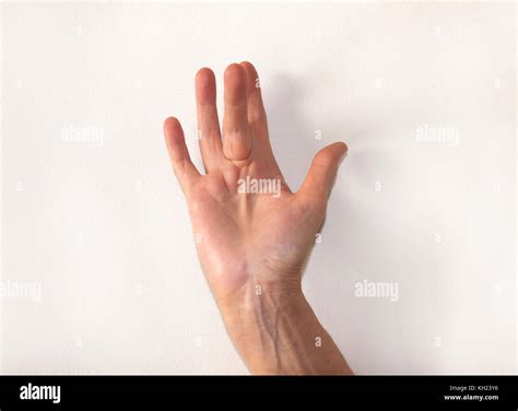 Dupuytrens Contracture High Resolution Stock Photography And Images Alamy