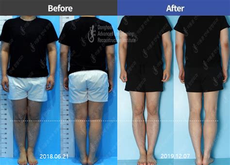 Leg Lengthening Surgery Body Builder