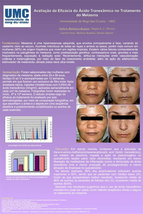 Melasma e Ácido Tranexâmico, uma nova abordagem terapeutica