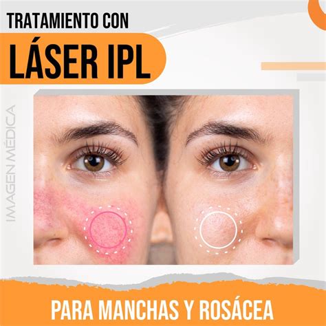 El Tratamiento De La Rosácea Con Láser Ipl Luz Pulsada Intensa