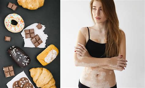 Foods You Should Avoid If You Have Vitiligo