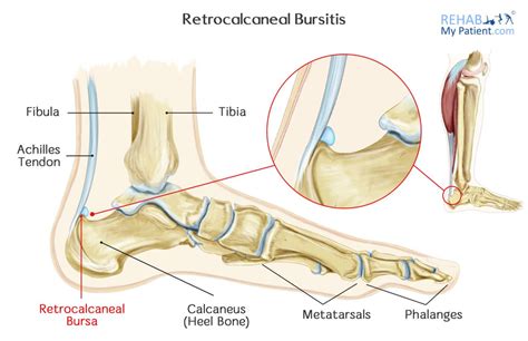 Retrocalcaneal Bursitis Rehab My Patient