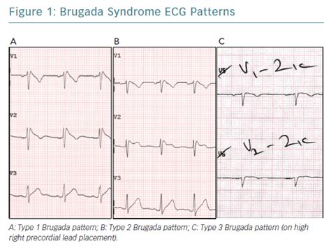 Brugada Syndrome ECG Patterns | AER Journal