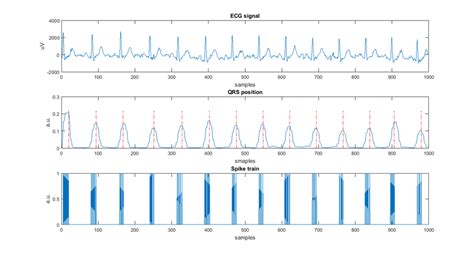 Zoomed Part Of The Ecg Signal And Respective Generated Spike Trains